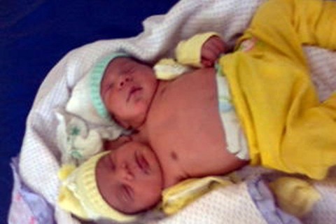 kétfejű-baba (sziámi ikrek, Emanoel és Jesus)