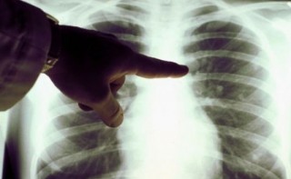 TBC-s tüdő (tbc, szűrés, antsz, )