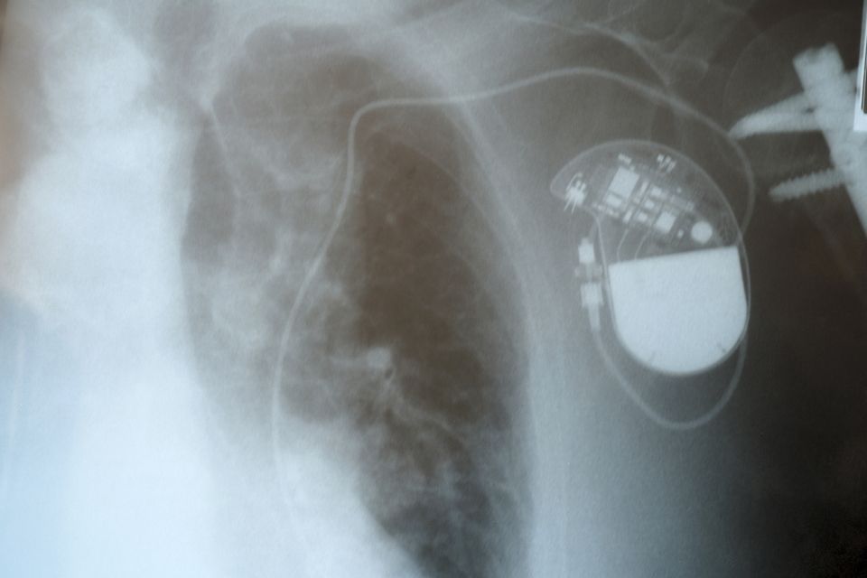 pacemaker (pacemaker, )