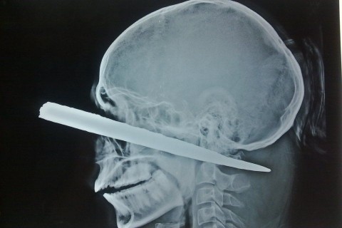 koponya röntgen (koponya röntgen)