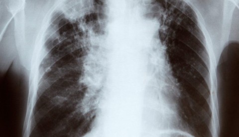 tüdő (tüdő röntgen)