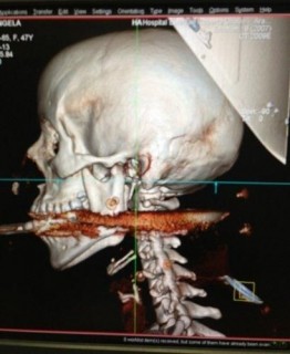 Szigony a fejbe röntgen (szigony, röntgen, )
