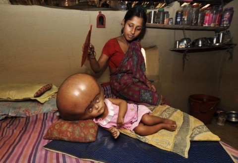 vízfejűség (vízfejűség)