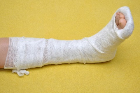 törött láb (törött, gipsz, )