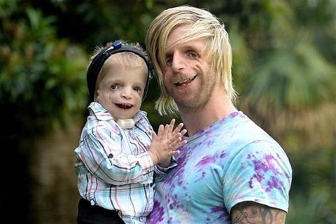 jono-es-zackary(960x640).jpg (genetikai rendellenesség, )