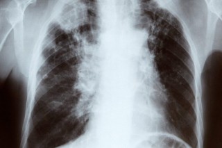 tüdő (tüdő röntgen)