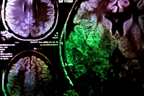 agy (agy, röntgenkép, )