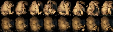 Dohányos magzatok (magzatok, ultrahang, )