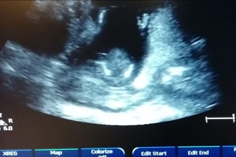 ultrahang-kep(960x640).jpg (ultrahang, magzat, )