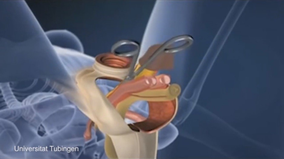 Péniszeltávolítás, hüvelytágítás: Videón egy nemátalakító műtét (18+)