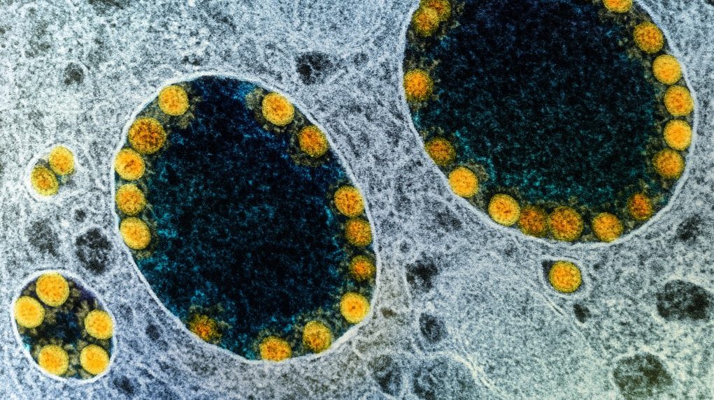 Izraelben megjelent a flurona: egy nő influenzával és koronavírussal is megfertőződött