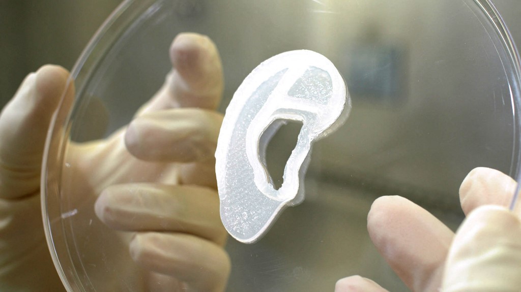 3D-nyomtatással készült fület kapott egy nő