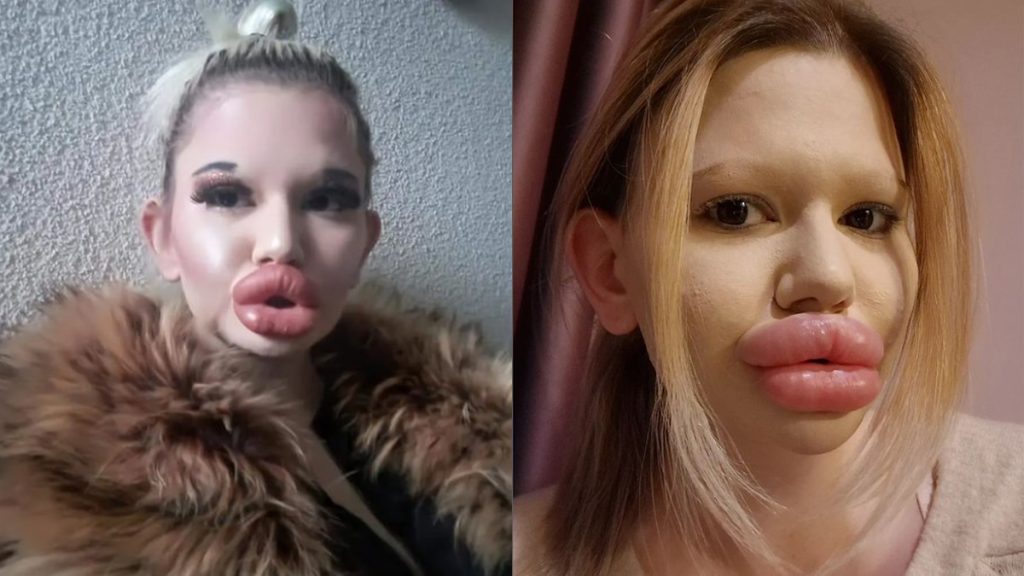 A világ legnagyobb ajkú nője a világ legnagyobb arccsontú nőjének címére is pályázik