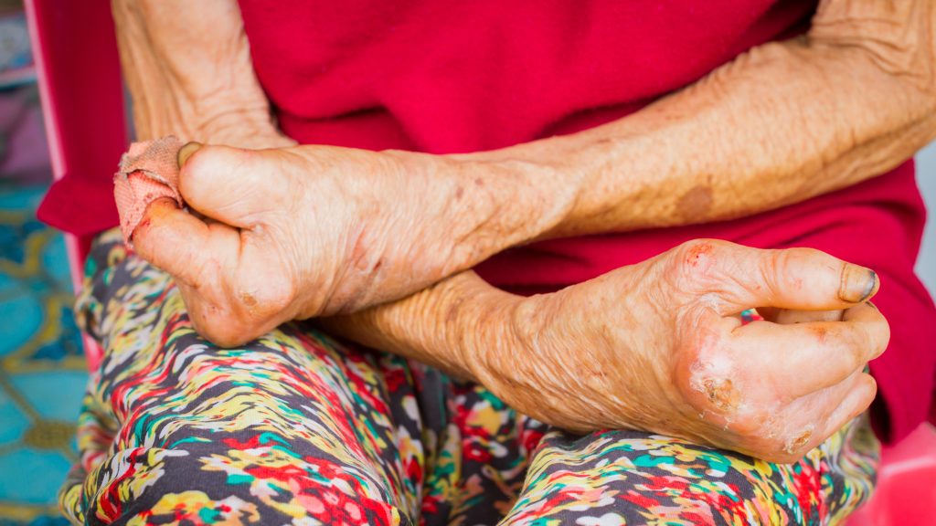 Leprosy is on the rise in the United States
