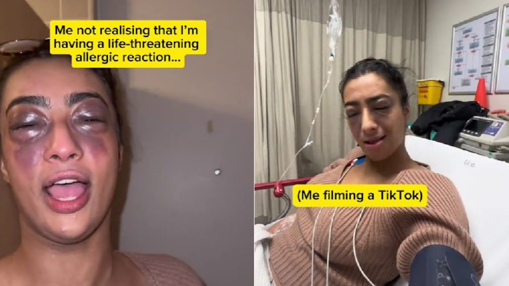 Videózgatott az influenszer, miközben súlyos allergiás reakciót váltott ki nála a mogyoró