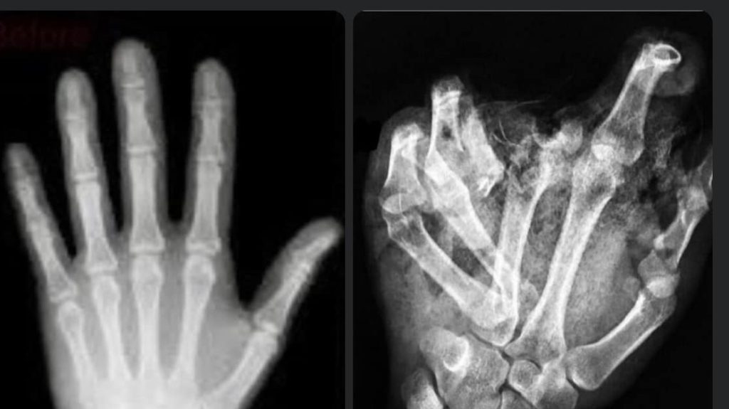 Ijesztő előtte-utána röntgenképekkel figyelmeztetnek a petárdabalesetekre a mentők