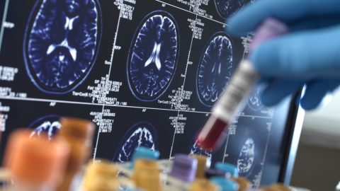 Kiderült, miért nem hatottak az eddigi Alzheimer-gyógyszerek