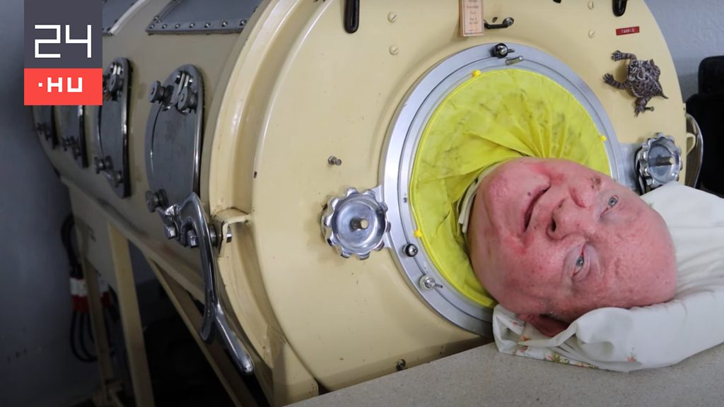 Paul Alexander, who lived in an iron lung for more than 70 years, has died