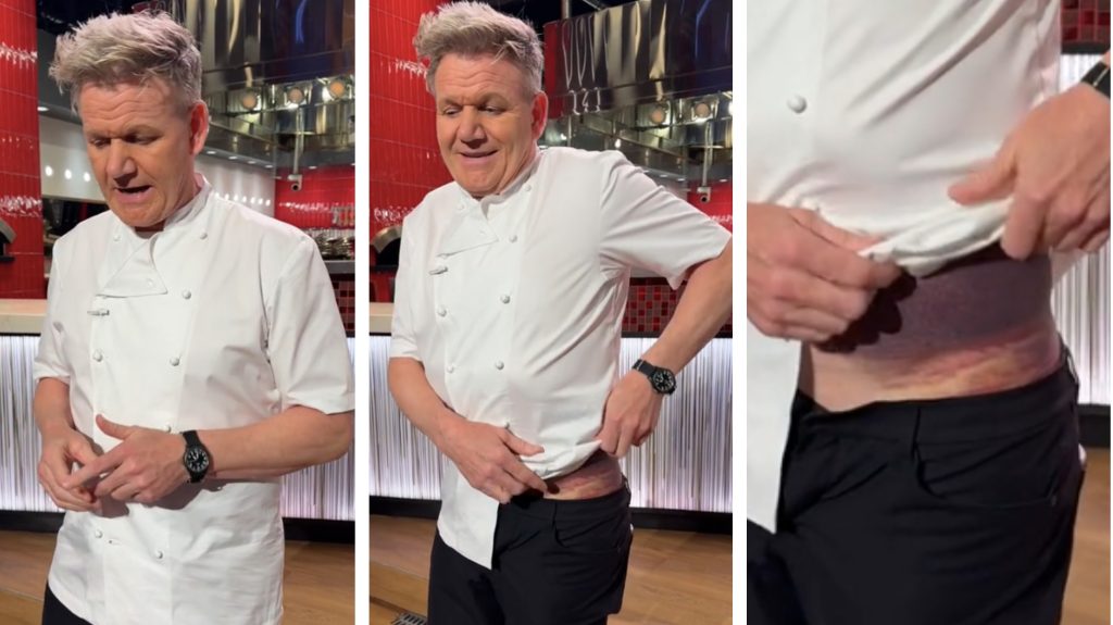 Horrorsérülést szenvedett biciklizés közben Gordon Ramsay: megmutatta a nyomait