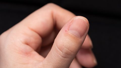 6 furcsa tünet, amelyekről nem gondolnád, hogy vashiányra utalnak