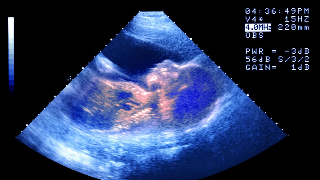 Lezárult a vizsgálat a tévesen halottnak nyilvánított magzat ügyében Zuglóban