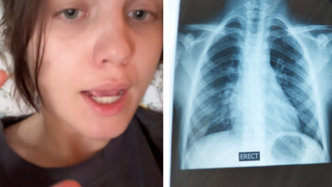 Elmesélte a TikTokon, hogy megette a saját bordáját a műtétje után