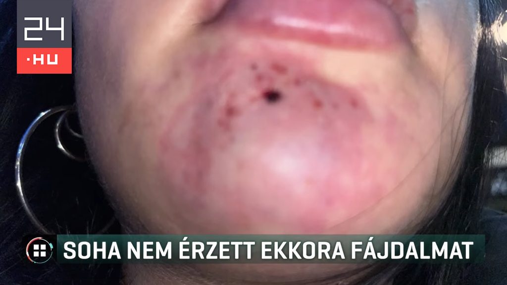 Szájfeltöltés után kórházba került egy 21 éves nő, az Orvosi Kamara plasztikai sebésze szerint heti szinten találkoznak hasonló esetekkel