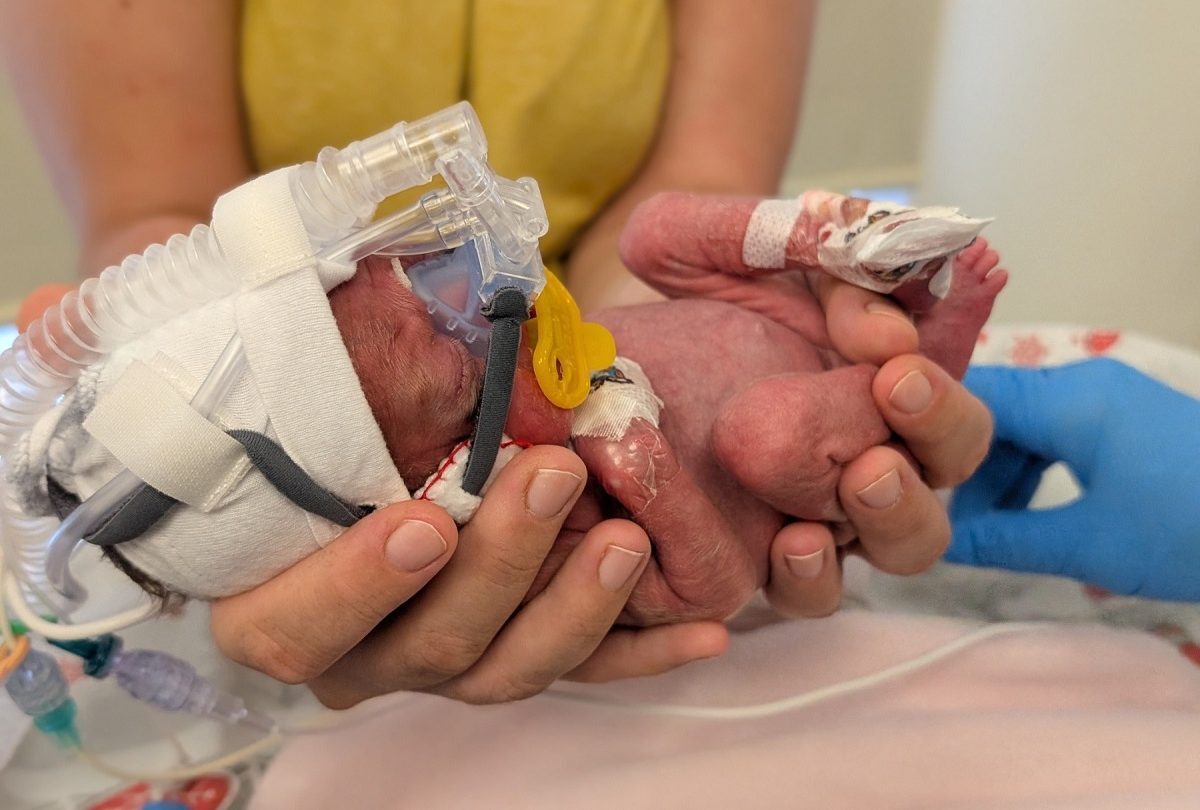 100 nap után hazaengedték a 690 grammal született Alexát a Honvédkórházból