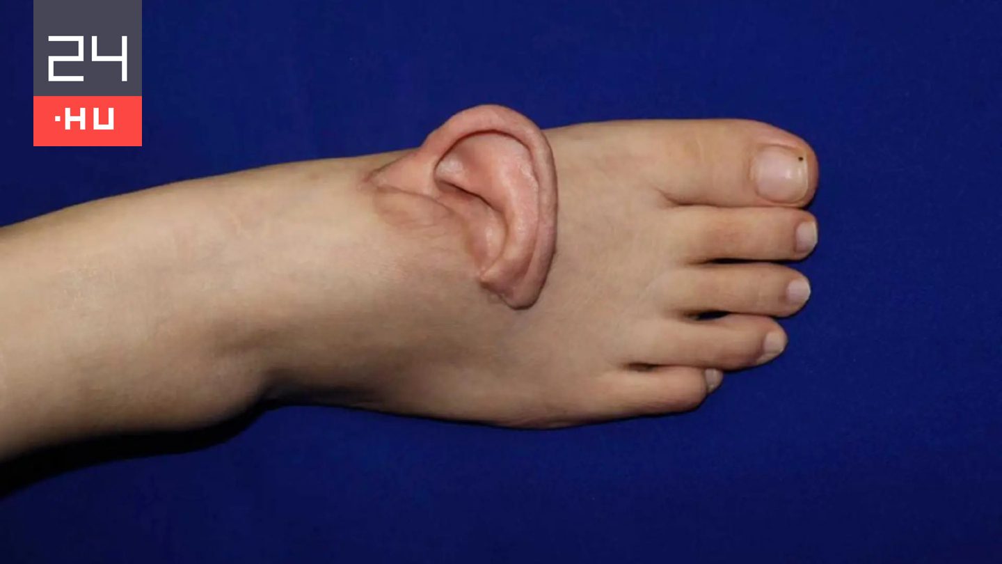 Lábfejére varrták fel a leszakadt fülét egy nőnek Kínában