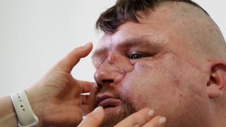 ukrajnai háború arcplasztika Artem