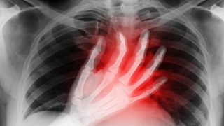 műtét, átültetés, transzplantáció, tüdő, kutatás, áttörés