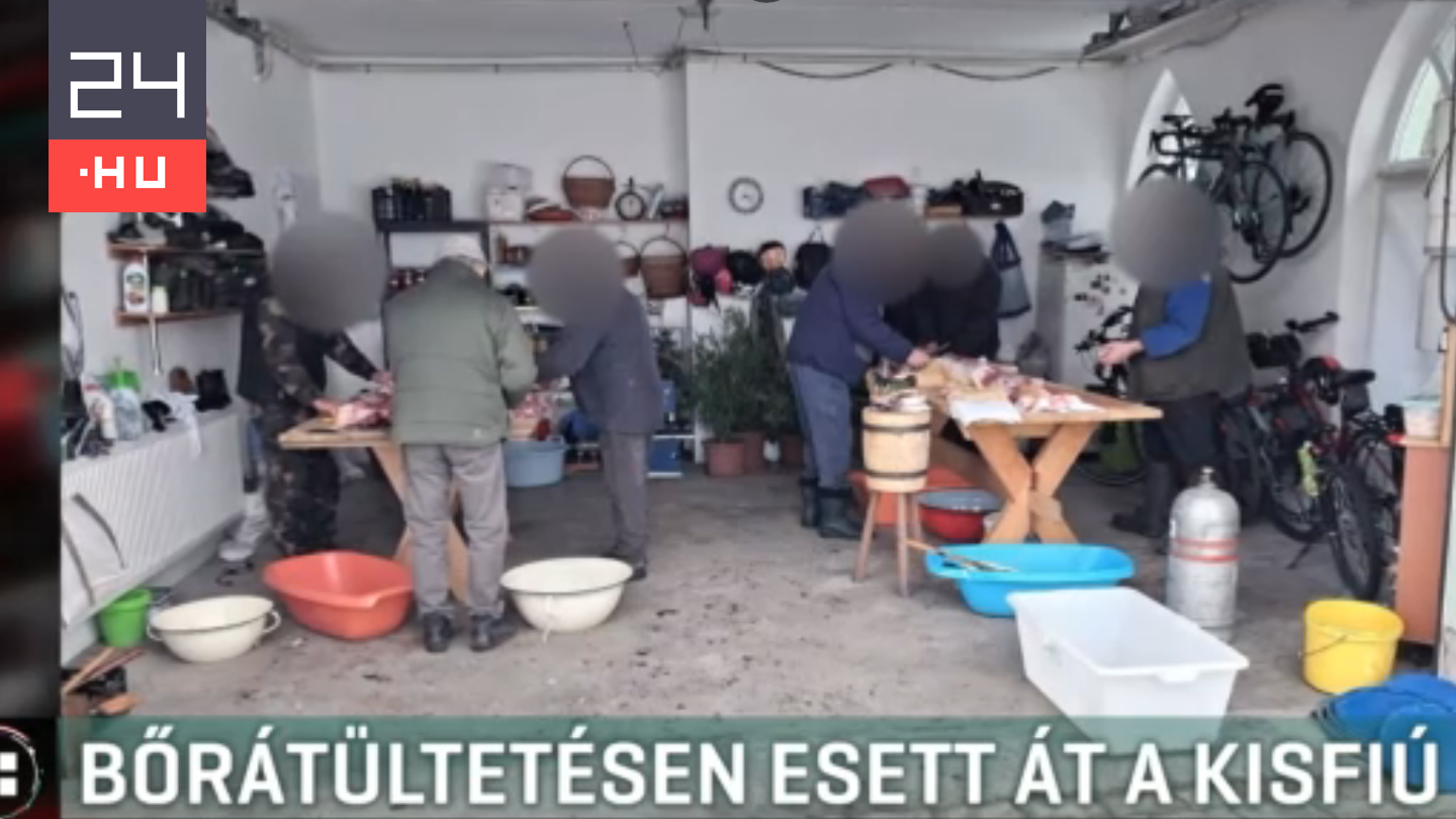 Megégett egy ötéves kisfiú egy disznóvágáson, bőrátültető műtéten esett át