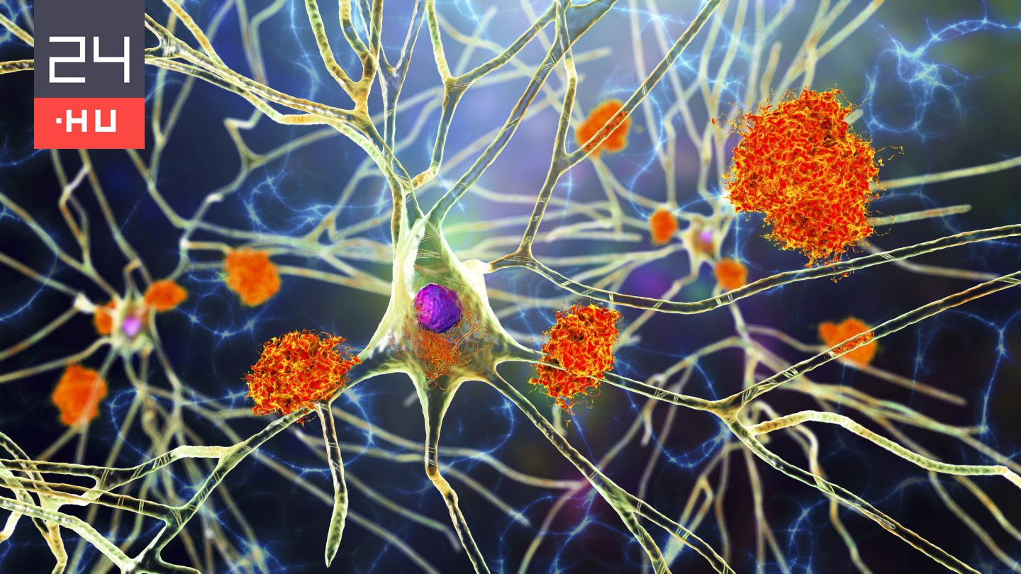 Véletlenül okozhatnak Alzheimer-kórt az agy tisztítósejtjei