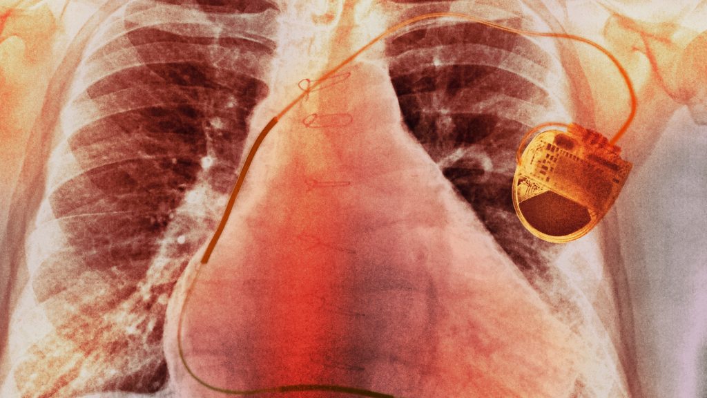 Megalkották a pacemakert, amit aksi helyett a szív lát el energiával