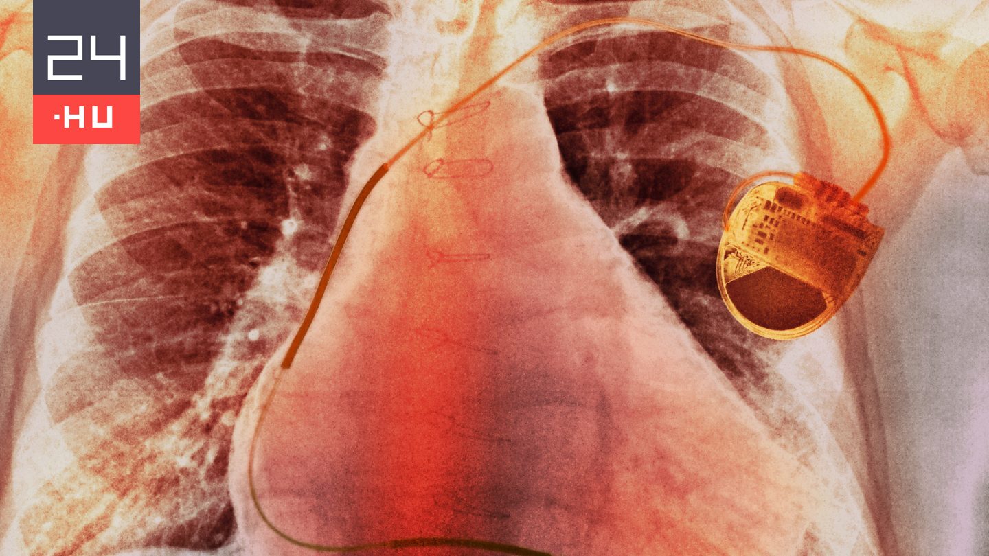 Megalkották a pacemakert, amit aksi helyett a szív lát el energiával
