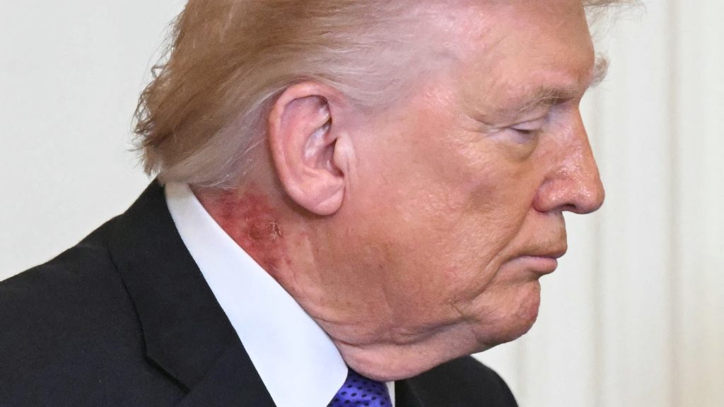 Rejtélyes vörös folt tűnt fel Donald Trump nyakán, a Fehér Ház orvosa nyilatkozatot adott ki