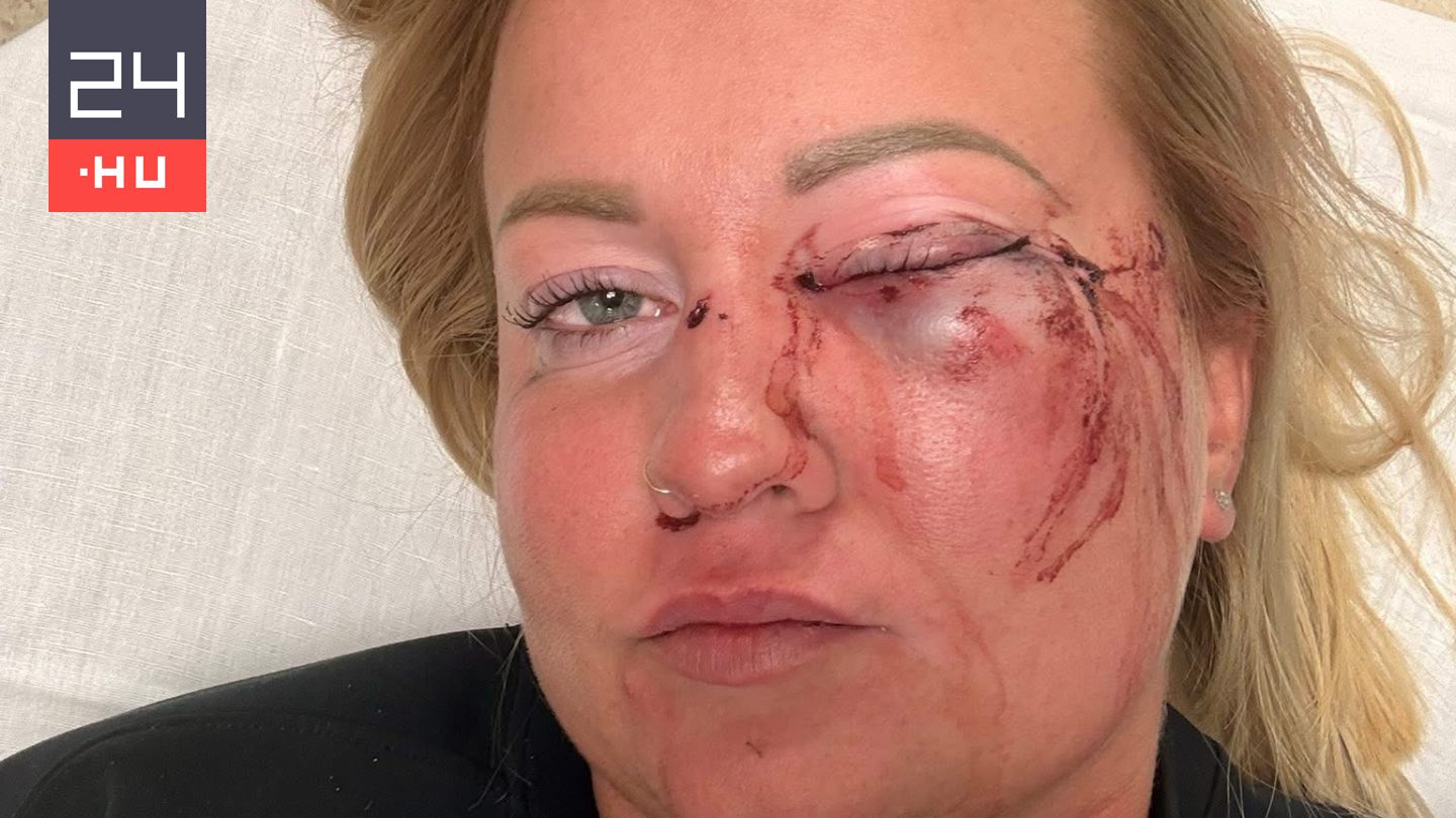 „Szarrá vert a fideszes alpolgármester” – súlyosan bántalmazott egy nőt Szentmártonkáta alpolgármestere, a kormánypárti jelölt elhatárolódik tőle