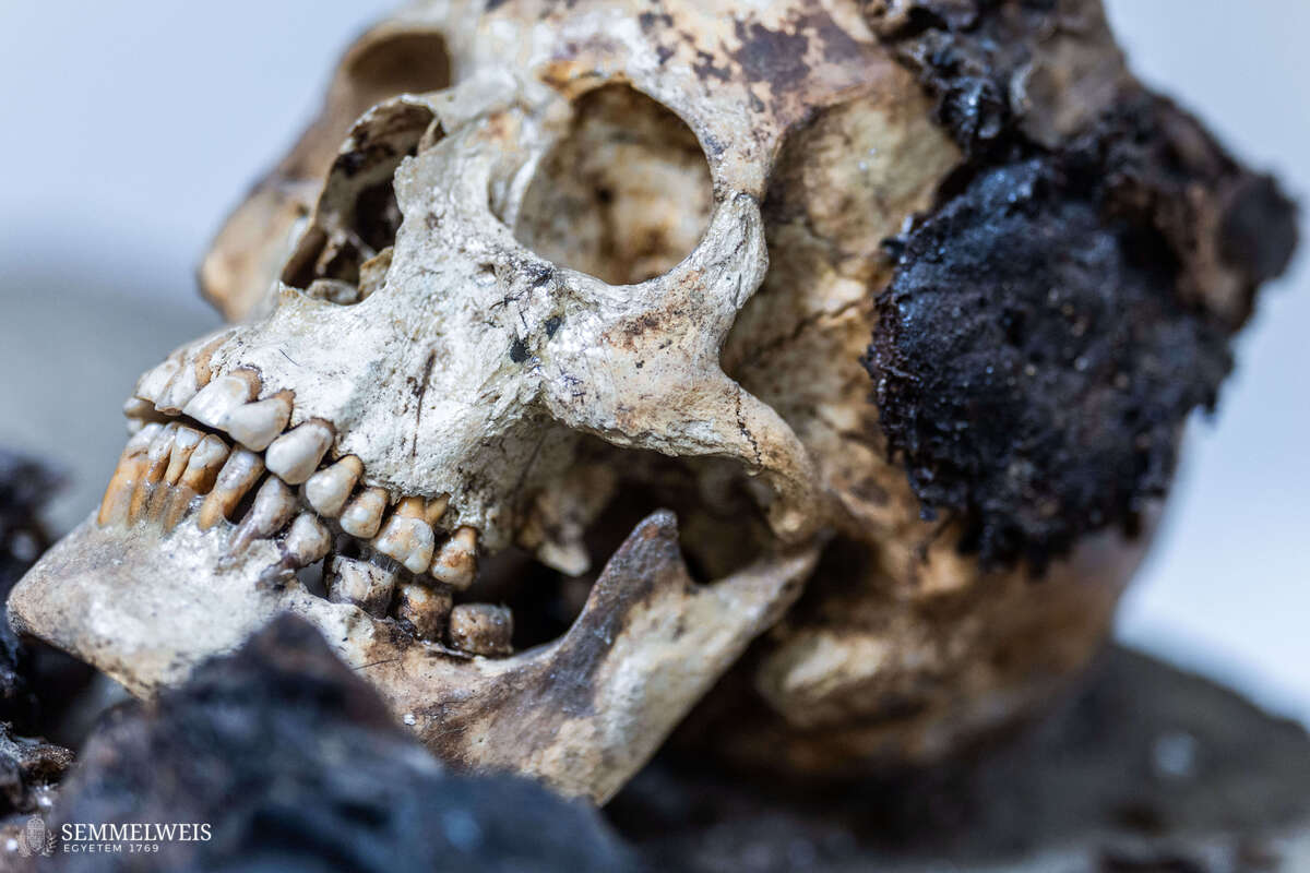 CT-vizsgálatnak vetettek alá egy Budapesten talált, római kori múmiát.