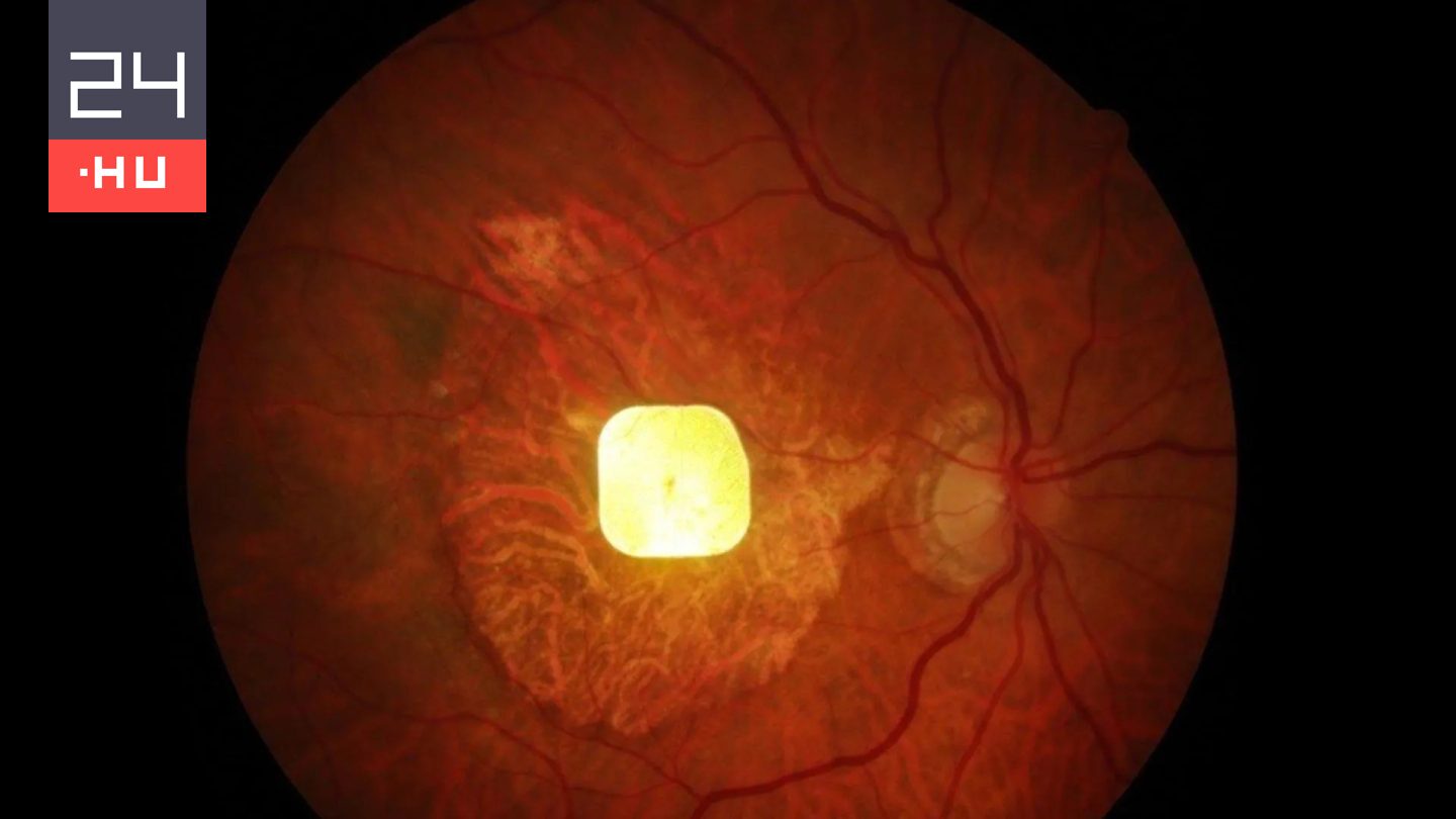 Milliók látását adhatja vissza egy új, kísérleti eszköz