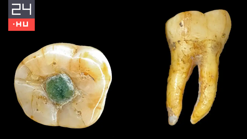 A maják drágakövet használtak fogtömésre