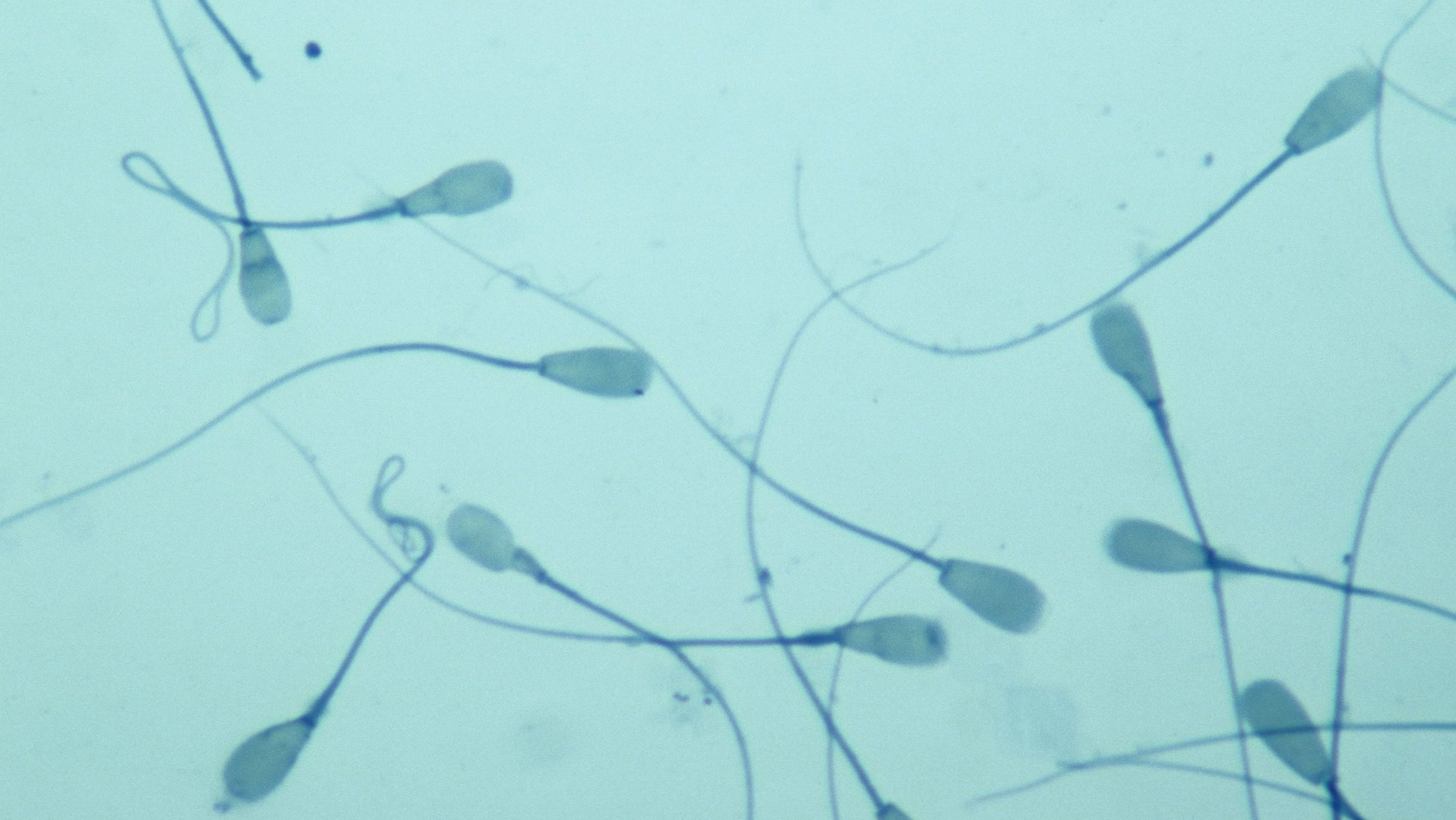 sperma, spermium, termékenység, kemoterápia, kutatás, műtét,